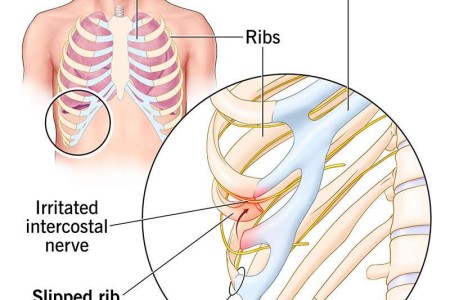 Slipping Rib Syndrome