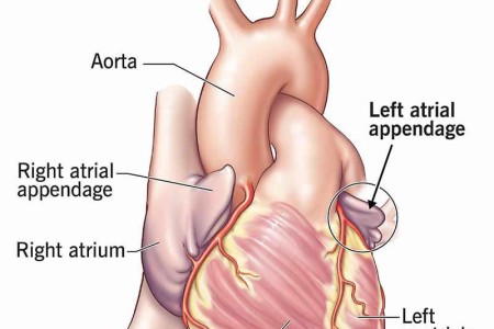 Left Atrial Appendage