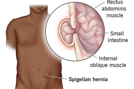 Spigelian Hernia
