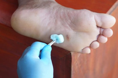 Did You Step on Broken Glass? Here’s How to Safely Get It Out of Your Foot