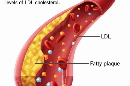 Familial Hypercholesterolemia