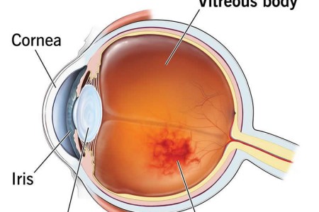 Vitreous Hemorrhage