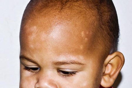 Pityriasis Alba