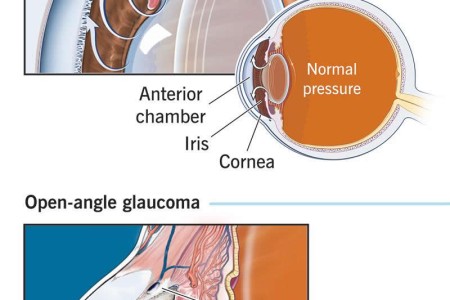 Open-Angle Glaucoma