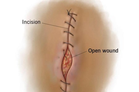 Wound Dehiscence