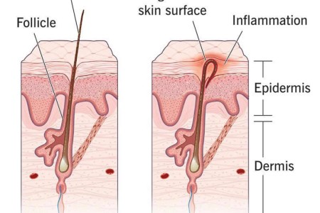 Ingrown Pubic Hair