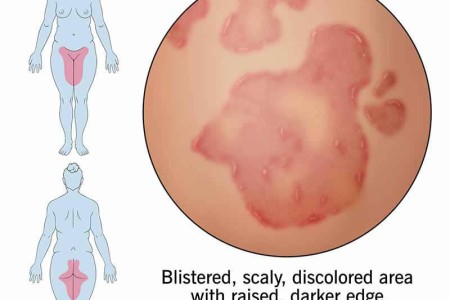Sexually Transmitted Fungal Infection (TMVII)