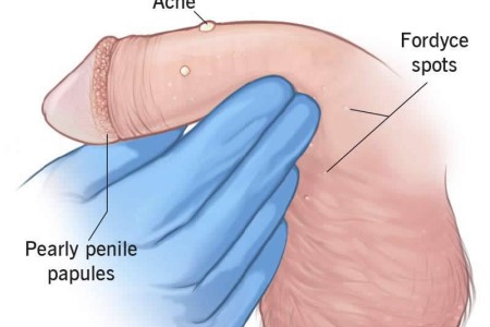 Pimple on Penis