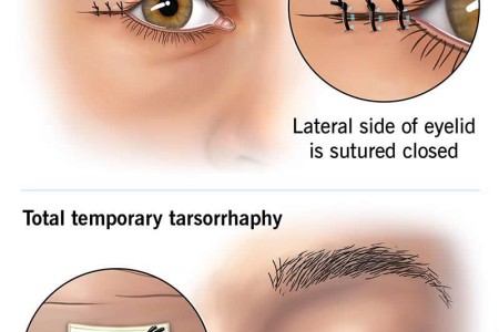 Tarsorrhaphy