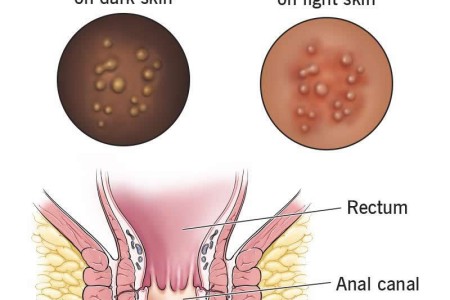 Anal Herpes