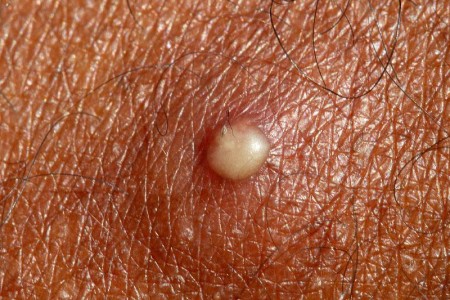 Pus