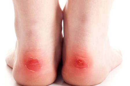 Friction Burn