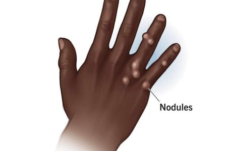 Rheumatoid Nodules