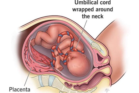Nuchal Cord