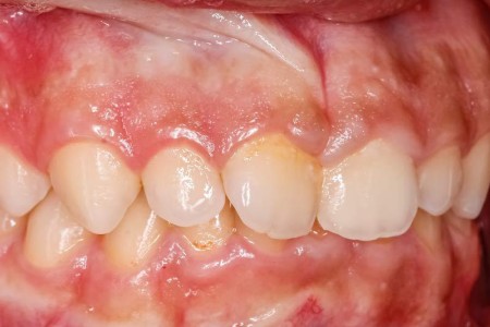 Gingival Hyperplasia