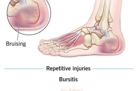Soft Tissue Injury