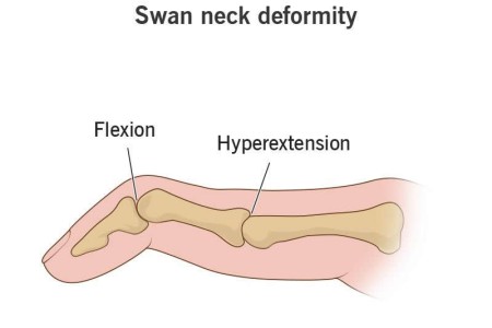 Swan Neck Deformity