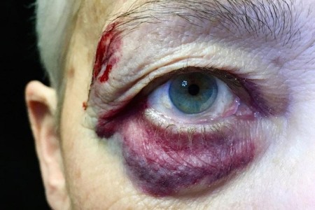 Black Eye