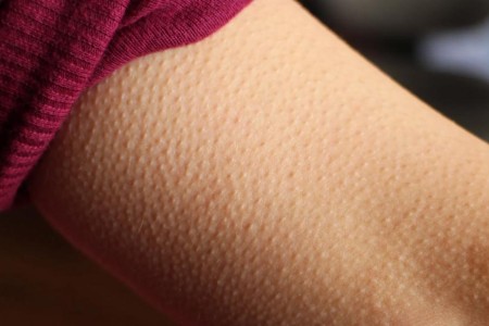 Why You Have ‘Goosebumps’ on Your Skin