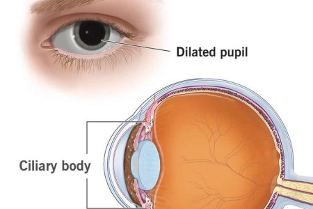 Cycloplegia