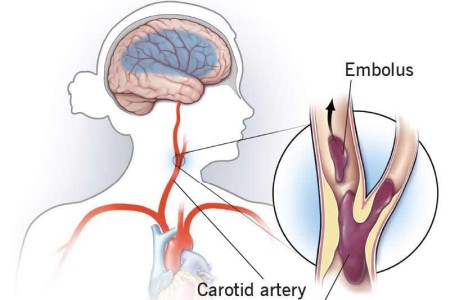 Thrombotic Stroke