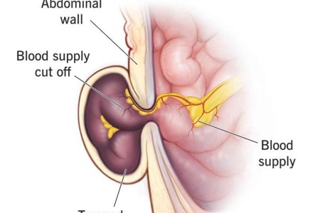 Strangulated Hernia