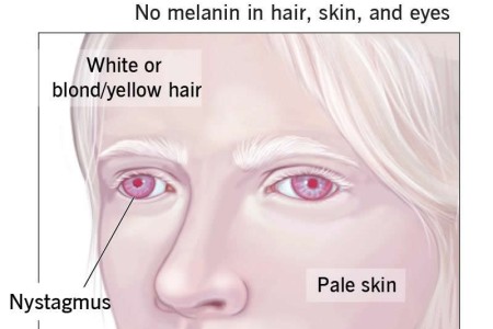 Oculocutaneous Albinism