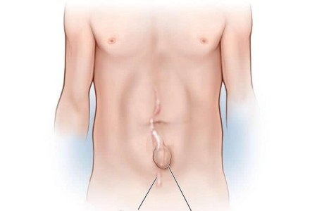 Incisional Hernia