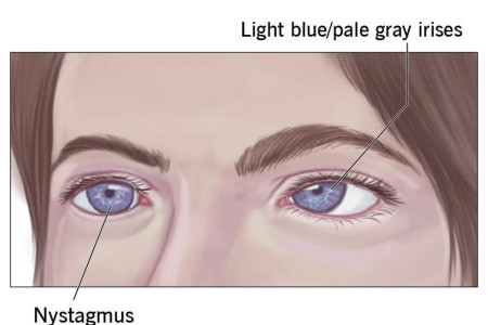 Ocular Albinism