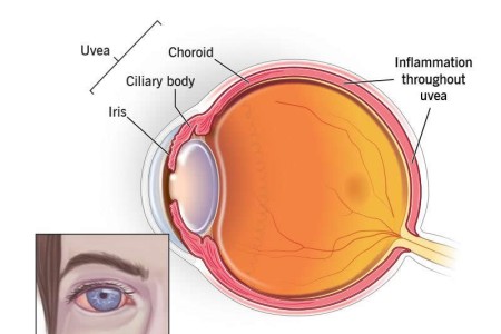 Panuveitis