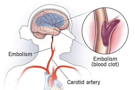 Embolic Stroke