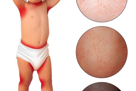 Heat Rash