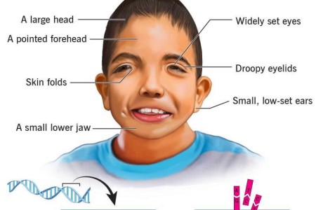 Jacobsen Syndrome