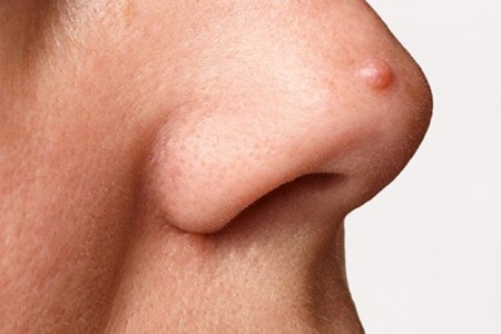 Fibrous Papule of the Nose