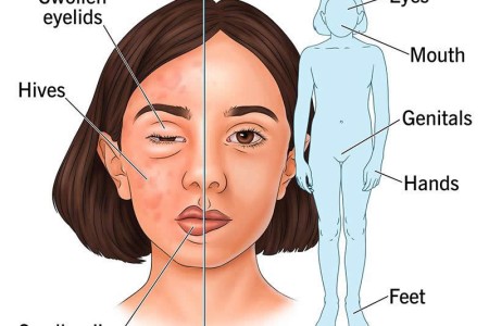 Hereditary Angioedema