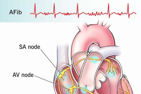 Atrial Fibrillation (AFib)