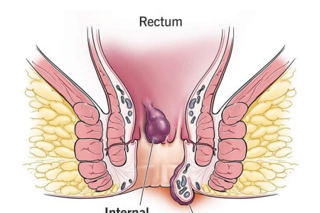 Prolapsed Hemorrhoid