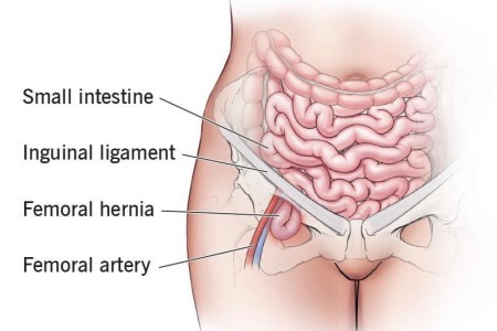Femoral Hernia