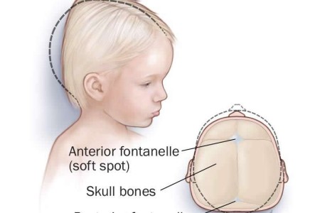 Brachycephaly