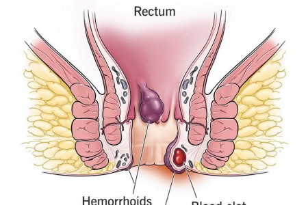 Thrombosed Hemorrhoid