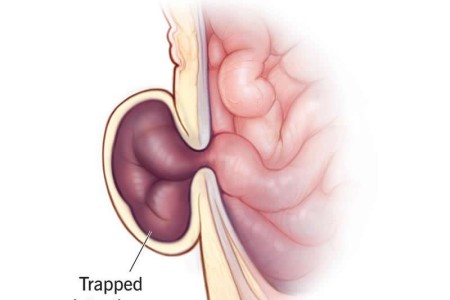 Incarcerated Hernia