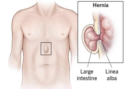 Epigastric Hernia
