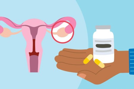 Berberine for PCOS: Benefits and Risks