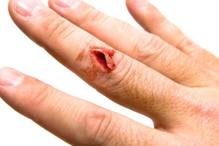 Laceration