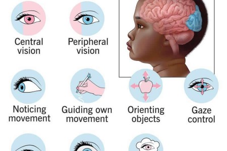 Cortical Visual Impairment (CVI)