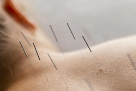 How Acupuncture Could Benefit Your Health