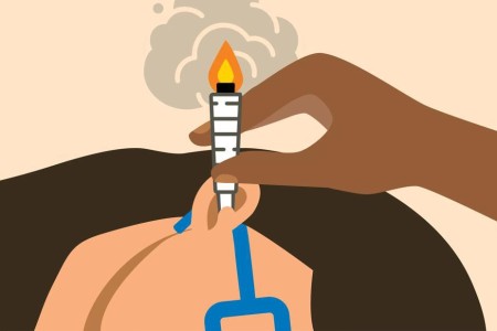 Ear Candling Is Both Ineffective and Unsafe