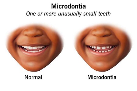Microdontia