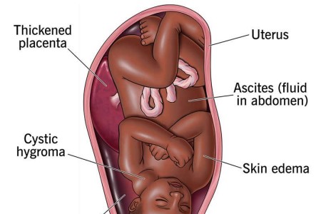 Hydrops Fetalis