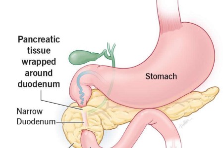 Annular Pancreas